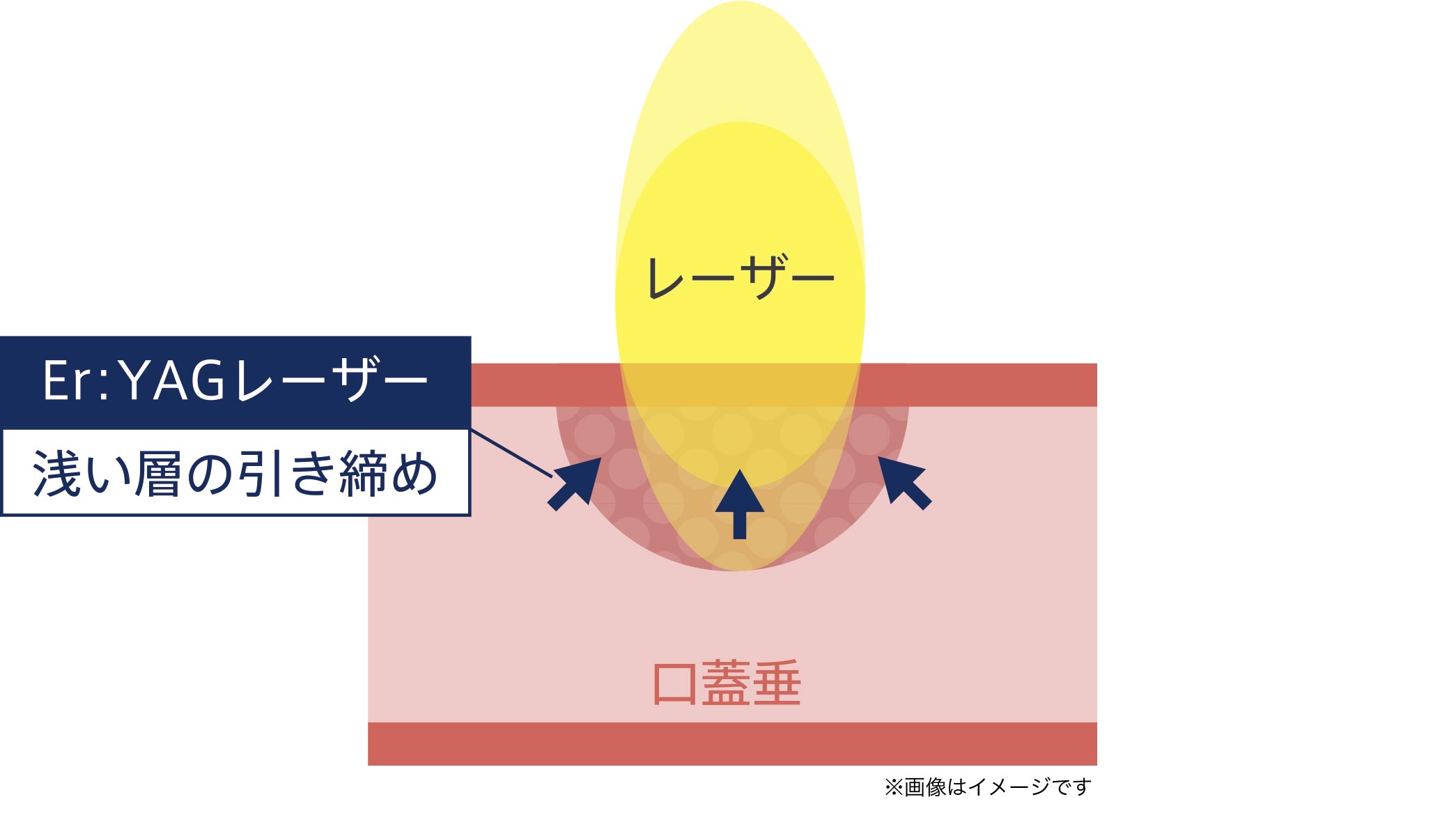 Er:YAGレーザー