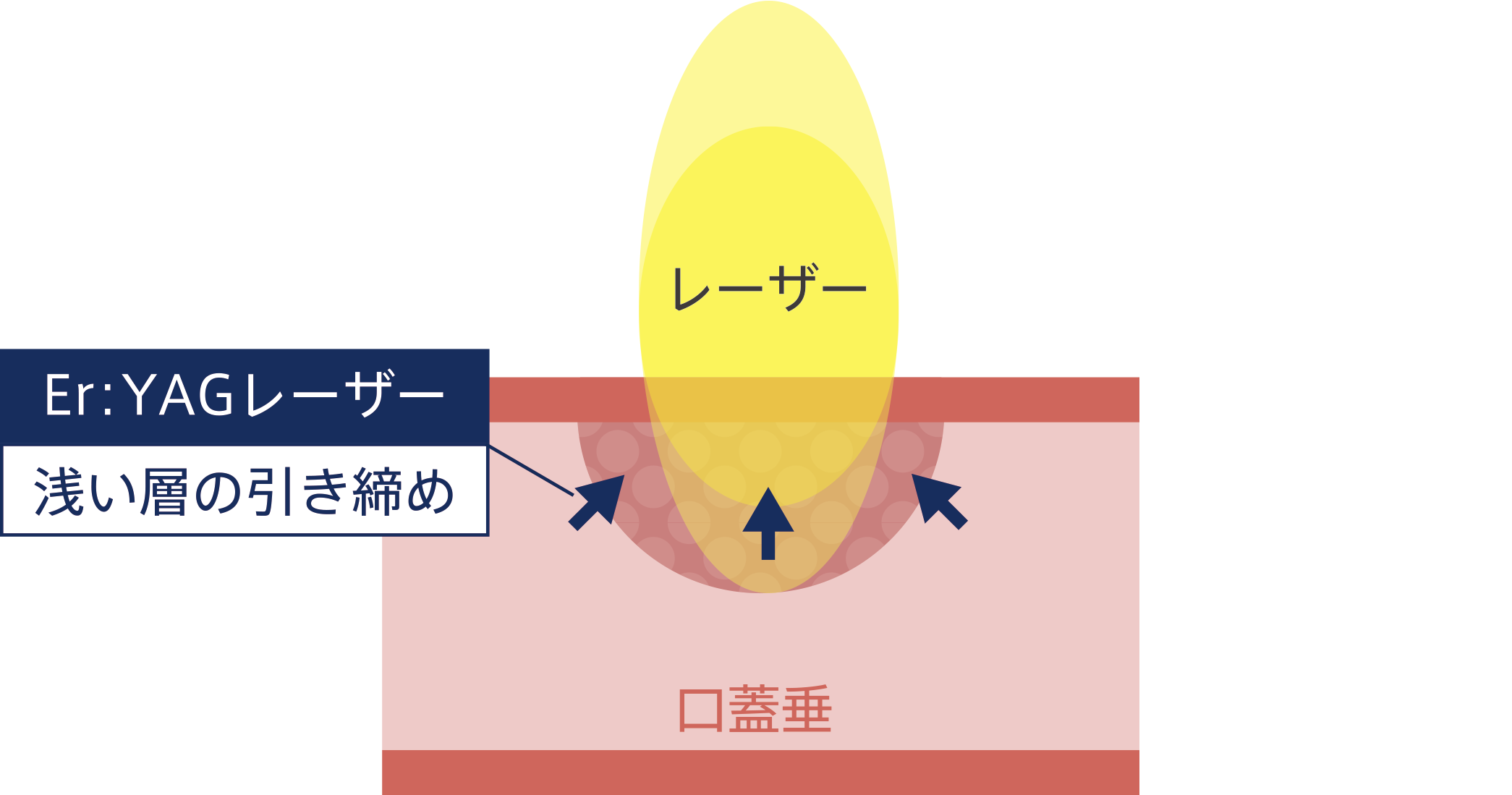 Er:YAGレーザー