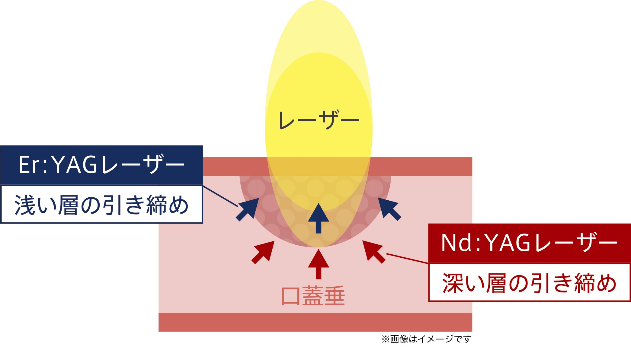 Nd:YAGレーザー