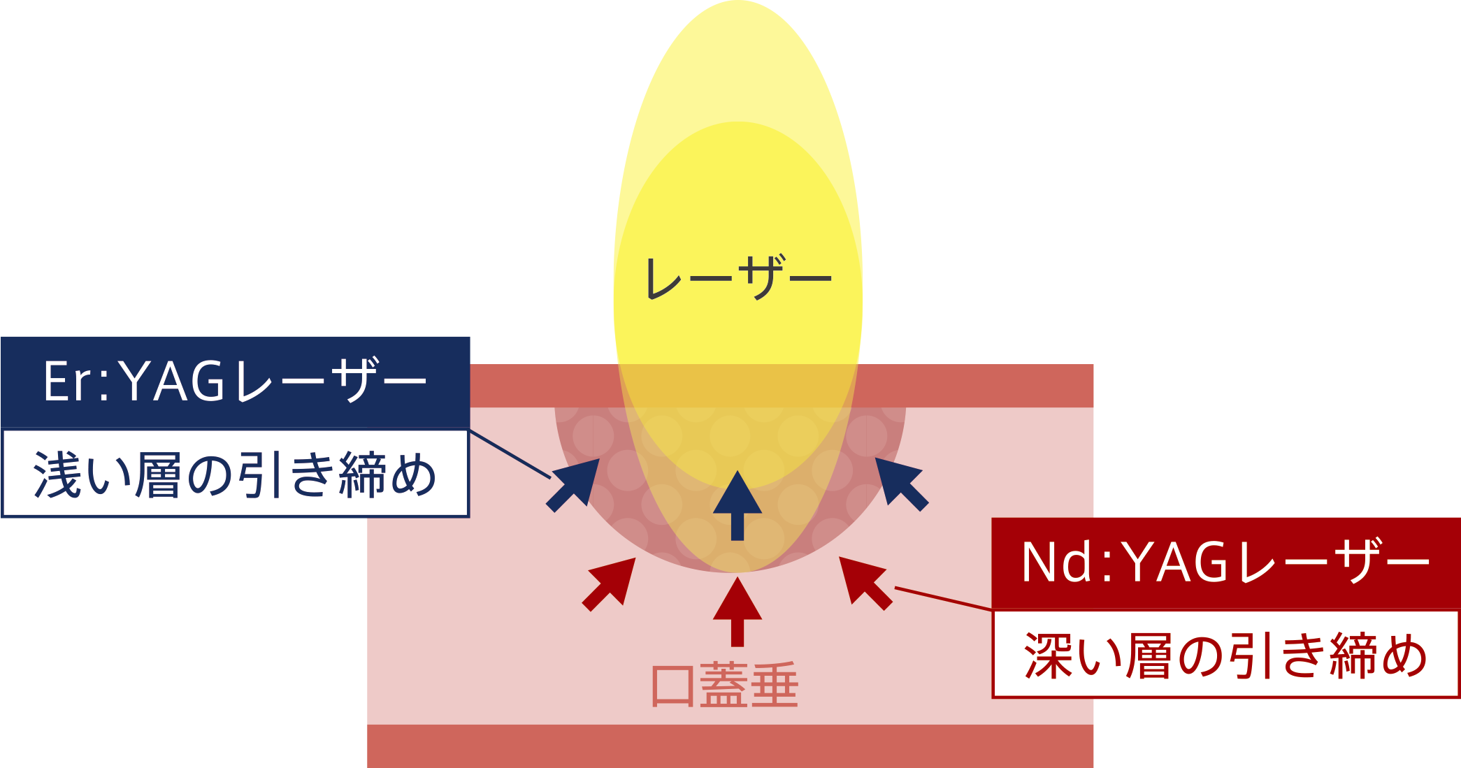 Nd:YAGレーザー