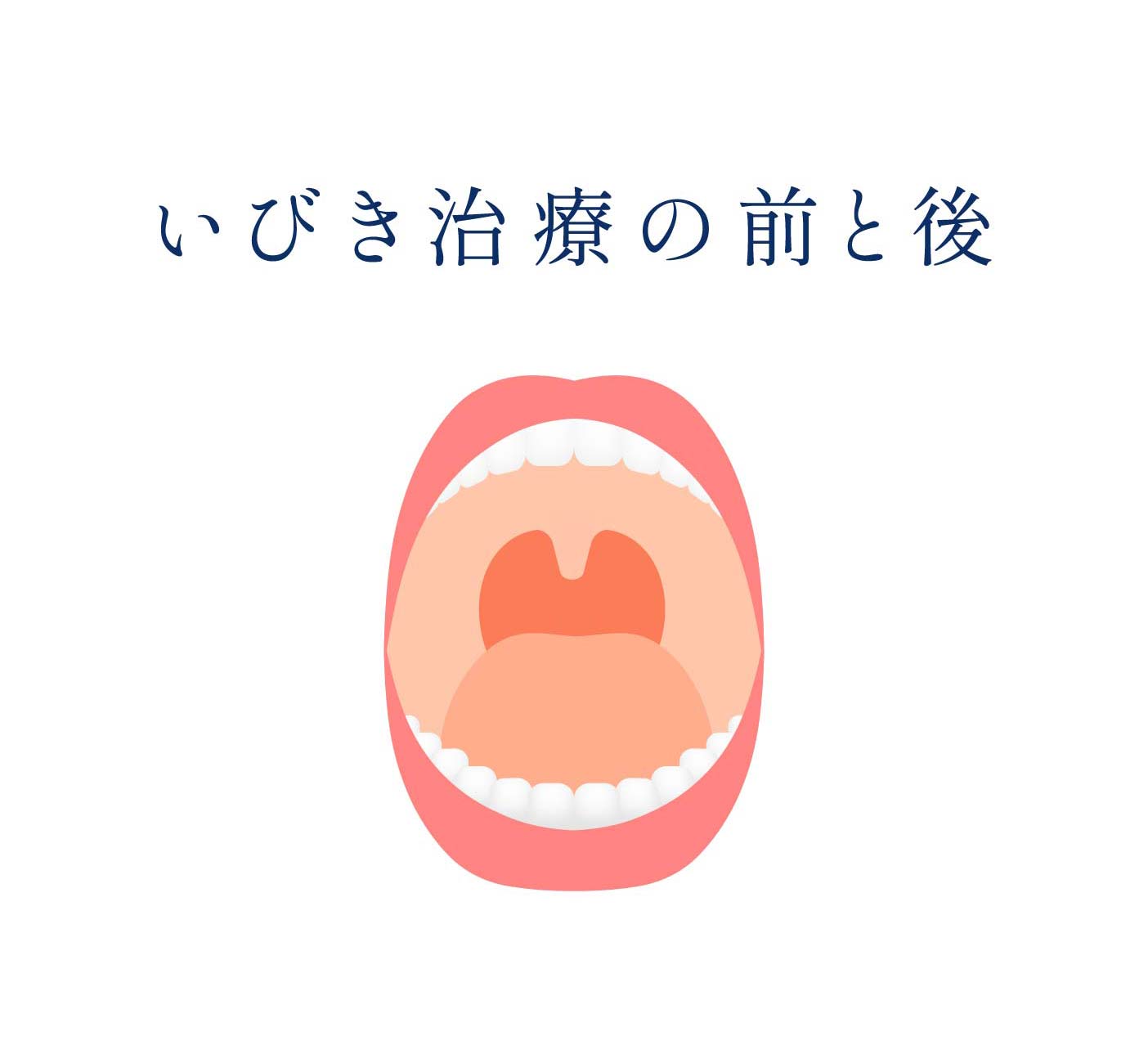 いびき治療の前と後ろ